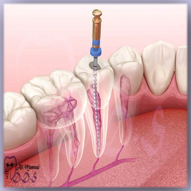 مزایا و معایب درمان ریشه (عصب‌کشی)